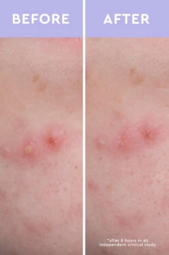 Spot A Spot Acne Patches -Justcuts Online Shop FBM BeforeAndAfter V3 2700x4070 f2f84d9b 64be 4433 83b7 c15a4915402b